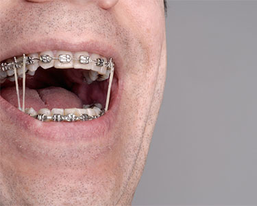 Orthodontic Rubber Bands in Spring, League City, & Cypress, TX