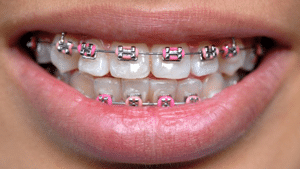 Braces The Orthodontic Studio Chevy Chase MD